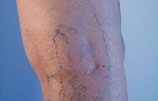 проширене вене на ногама код жена