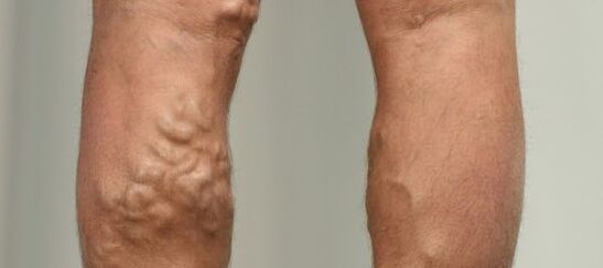 проширене вене на ногама