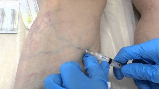 склеротерапија проширених вена на ногама код жена